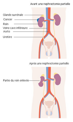 Image - nephrectomie-partielle.jpg