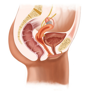 Image - incontinence-urinaire.jpg